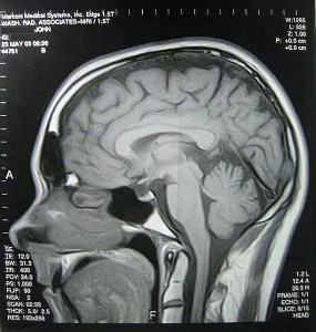 Cranial MRI. © Flickr user John M, 2003 (CC BY-SA 2.0) 