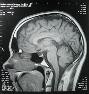 Cranial MRI. © Flickr user John M, 2003 (CC BY-SA 2.0)