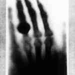 First medical X-ray by Wilhelm Roentgen, of his wife Anna Bertha Ludwig's hand. When she saw her skeleton, Anna is said to have uttered, "I have seen my death". By Wilhelm Röntgen (public domain).