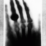 First medical X-ray by Wilhelm Roentgen, of his wife Anna Bertha Ludwig's hand. When she saw her skeleton, Anna is said to have uttered, "I have seen my death". By Wilhelm Röntgen (public domain).